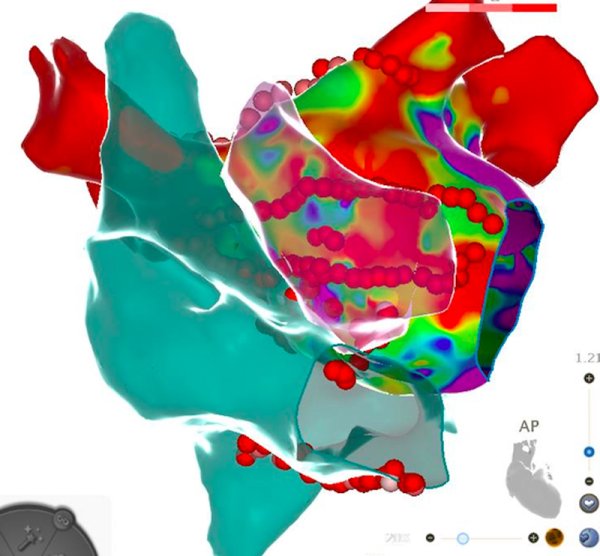 网上炒股配资 三维标测导航，毫米级修复“失控的心”！长期心乱、三症并发的她重获新生